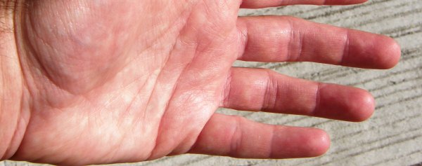 Dupuytren's usually starts when you're over 50 and is more common in men than it is in women